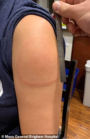 Moderna coronavirus vaccine leaves itchy and swollen skin/ red lumps on patient’s arms 7 to 10 days after getting vaccinated(photos)