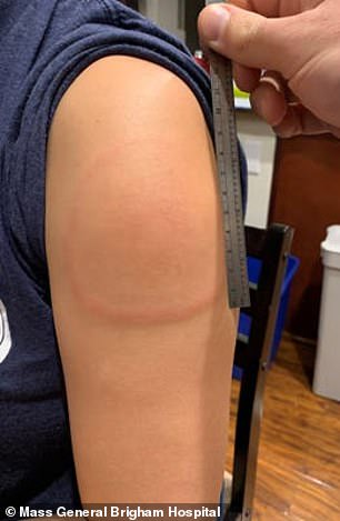 Rare 'COVID arm' side effect leaves people with red lumps after getting Moderna Vaccine (Photos) 