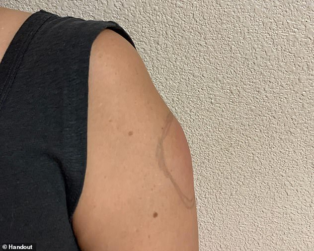 Rare 'COVID arm' side effect leaves people with red lumps after getting Moderna Vaccine (Photos) 