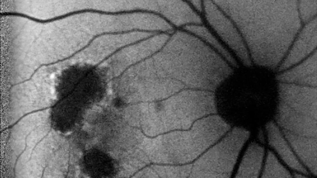 A closeup of black blood vessels and large dark spots on a gray background