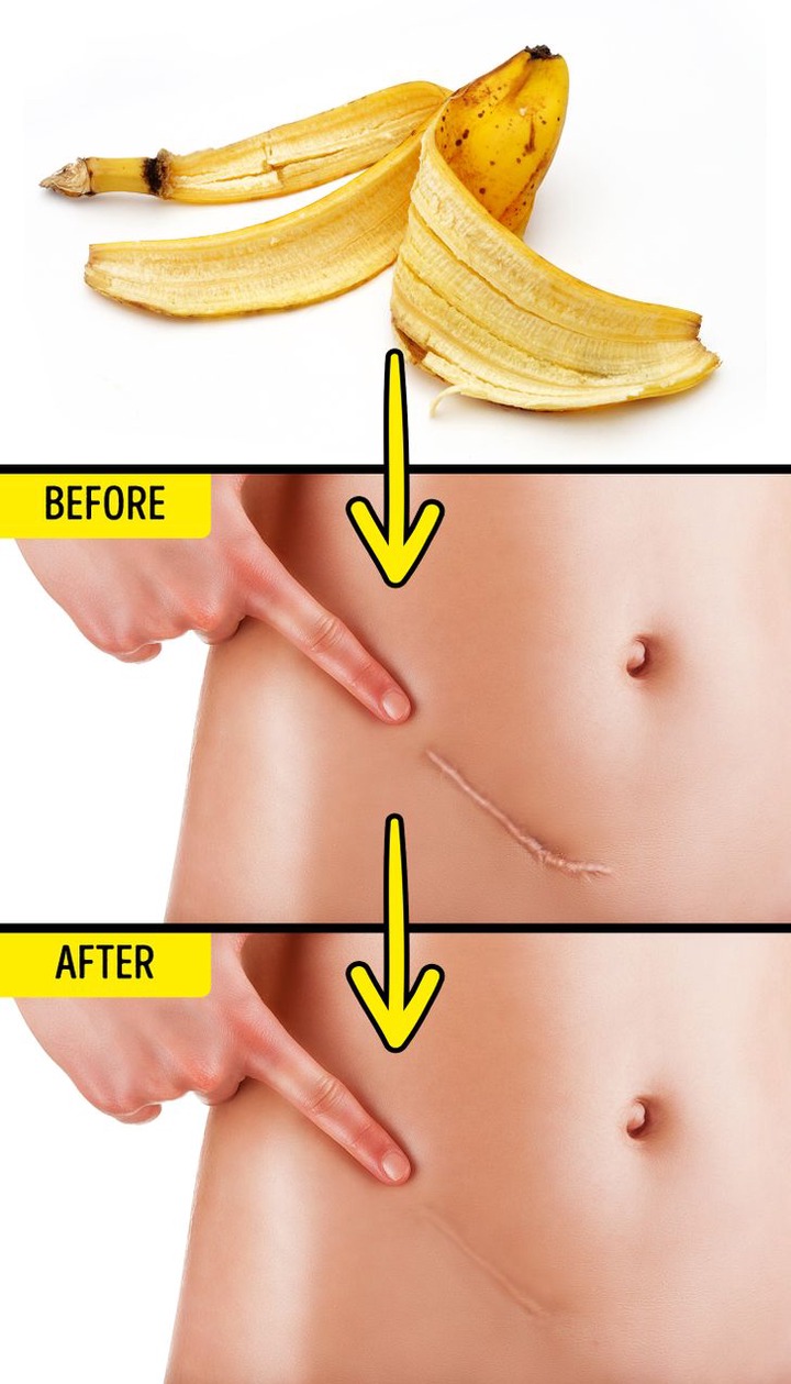 Banana peels benefits with reducing scar tissue 