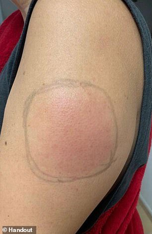 Rare 'COVID arm' side effect leaves people with red lumps after getting Moderna Vaccine (Photos) 