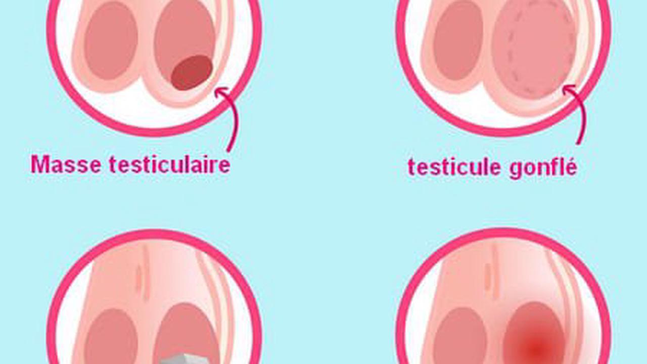 Cancer du testicule : symptômes, cause, âge, pronostic