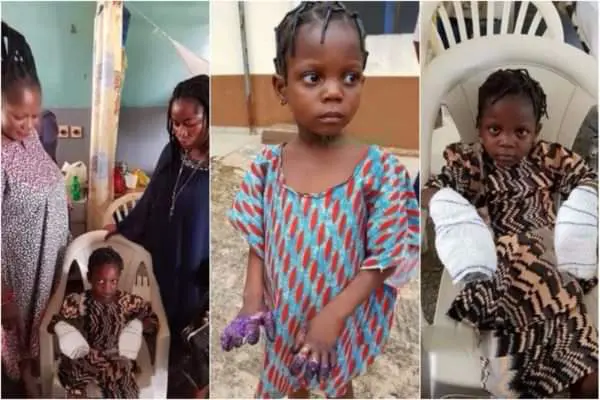 Image result for A Little Girl’s Hands Were Burnt By Grandmother for stealing Indomie