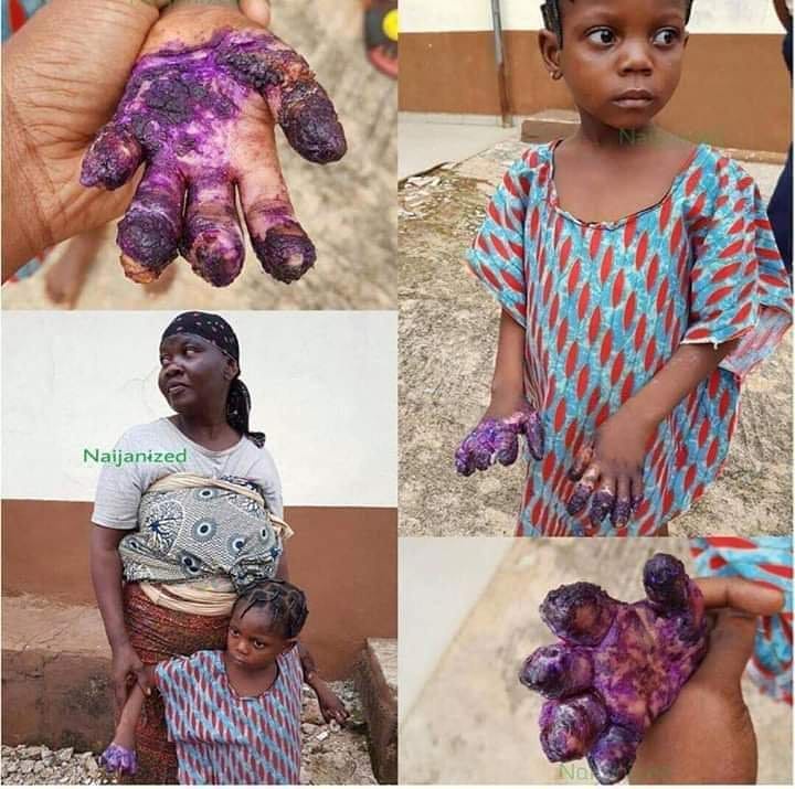 Image result for A Little Girl’s Hands Were Burnt By Grandmother for stealing Indomie
