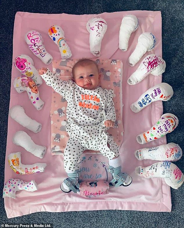 Baby Girl With Club Foot Is Pictured Surrounded By The 16 Casts She S Worn Since Birth After Successful Treatment Opera News