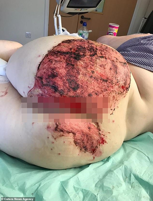 Woman suffers horrific burns on her buttocks after falling on a radiator pipe following an epileptic seizure (Photos)