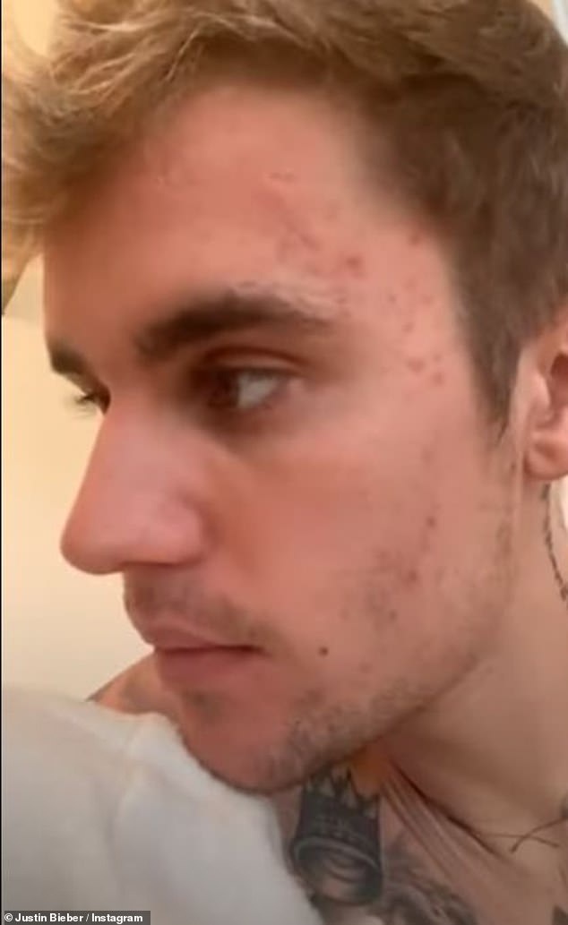 His struggle: And the blonde also said her husband Justin Bieber battles adult acne