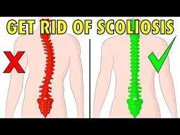 scoliosis - 1c90aaae705ba006644e15a0362c0555 quality hq format webp resize 720 - Read this to ascertain if you have scoliosis