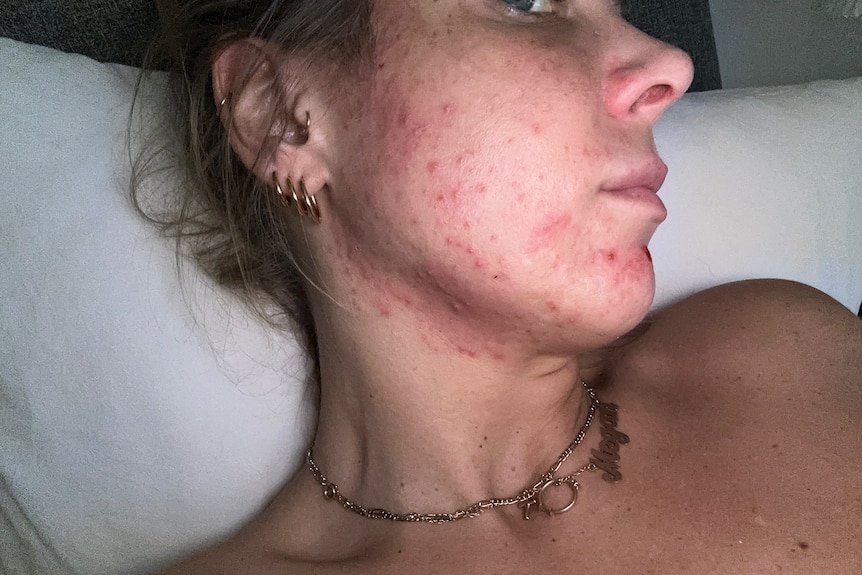 Megan Hancocks lying in bed showing skin issues on her face and neck after taking a knock-off weight loss drug.
