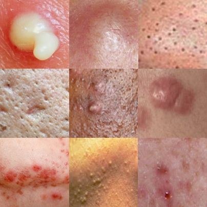 Different Types of Acne &amp; How to Treat Them Effectively With Natural Remedies - 1f4ab5d116190336022f1a5372e78834 quality uhq resize 720 - Different Types of Acne &amp; How to Treat Them Effectively With Natural Remedies
