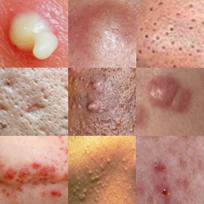 Different Types of Acne & How to Treat Them Effectively With Natural Remedies - 1f4ab5d116190336022f1a5372e78834 quality uhq resize 720 - Different Types of Acne & How to Treat Them Effectively With Natural Remedies - photo Different Types of Acne & How to Treat Them Effectively With Natural Remedies - 1f4ab5d116190336022f1a5372e78834 quality uhq resize 720 - Different Types of Acne & How to Treat Them Effectively With Natural Remedies
