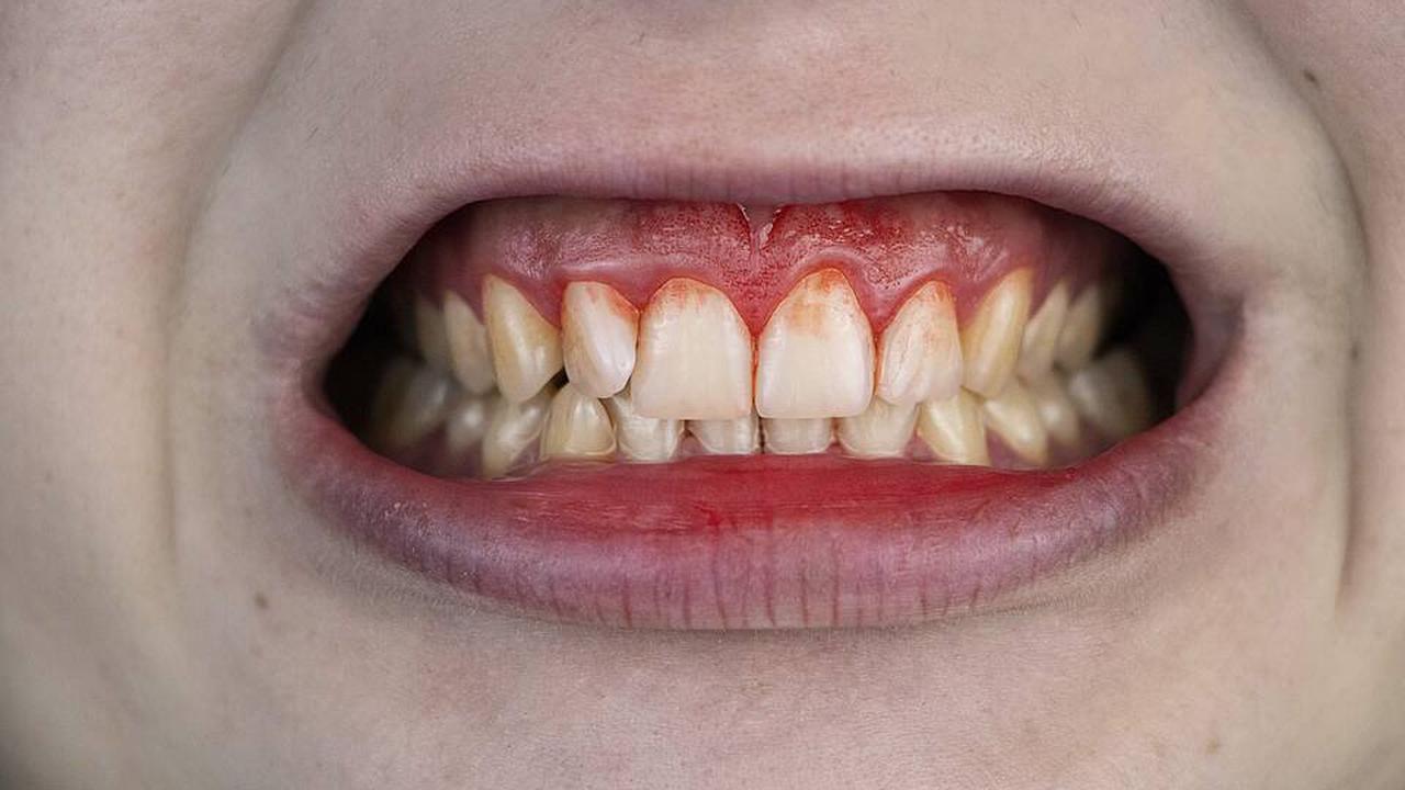 Was passiert im Mund bei Parodontitis?