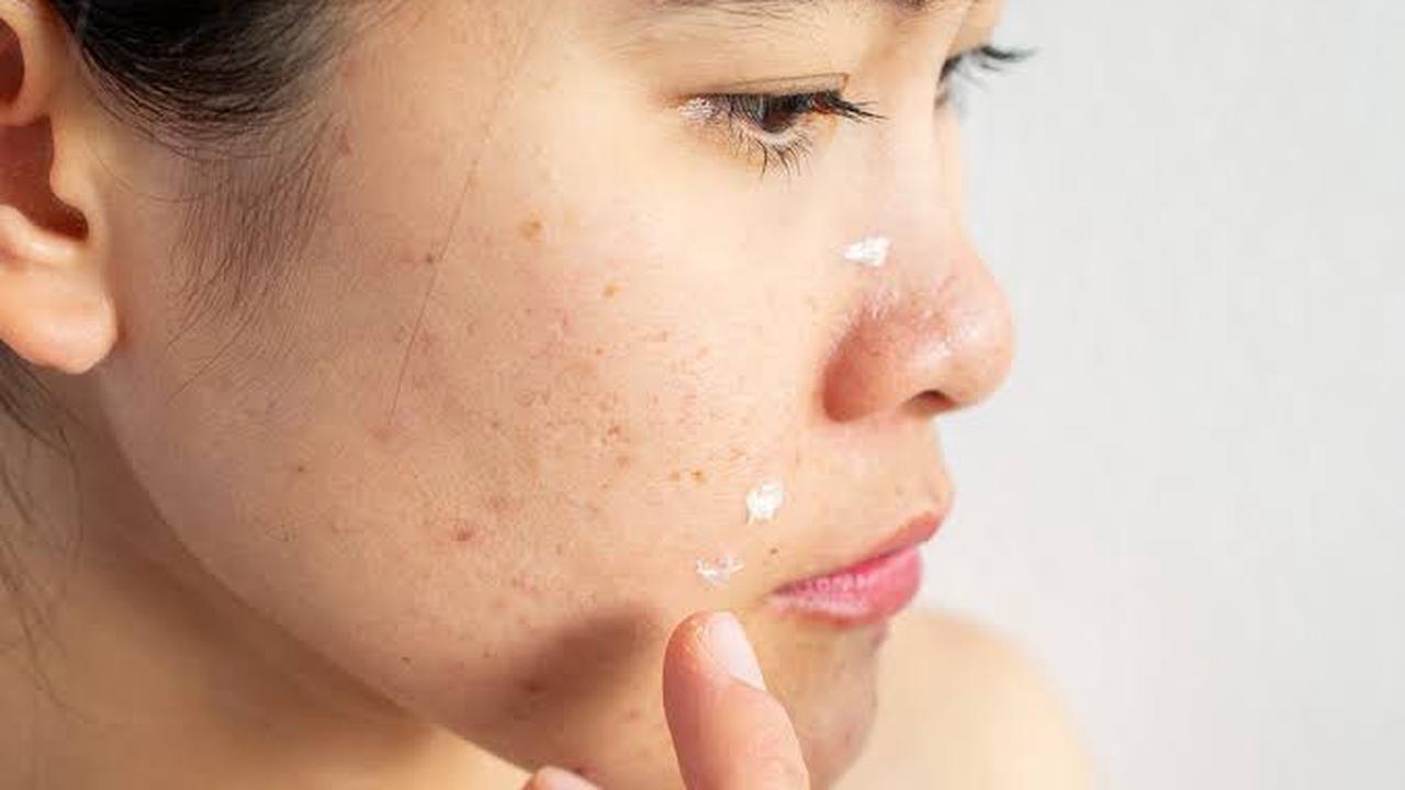 Getting rid of acne scars.