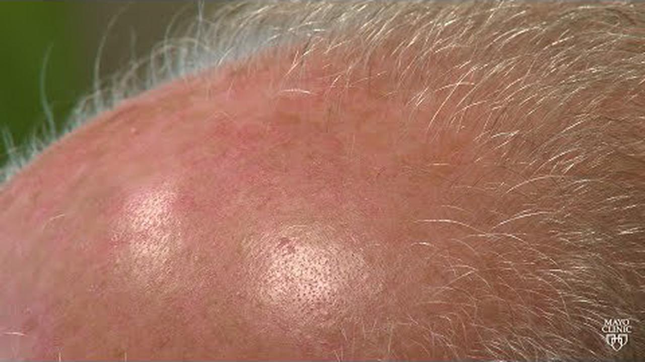 Mayo Clinic Minute: Dermatologist discusses male-pattern baldness