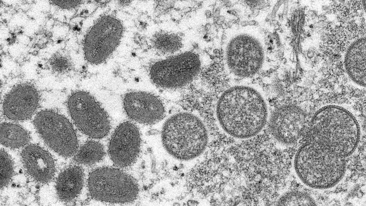 OMS: les cas de variole simienne triplent en deux semaines en Europe