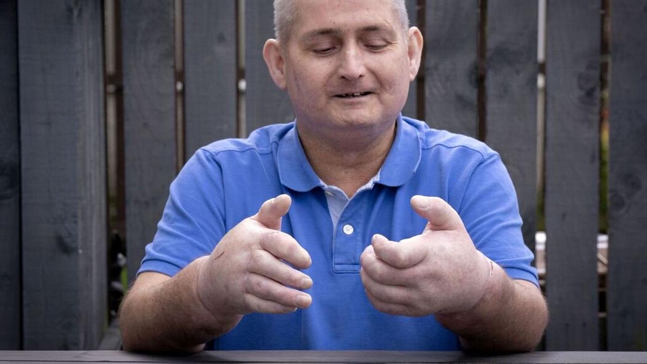 12-Stunden-Transplantation: Schotte erhält zwei neue Hände