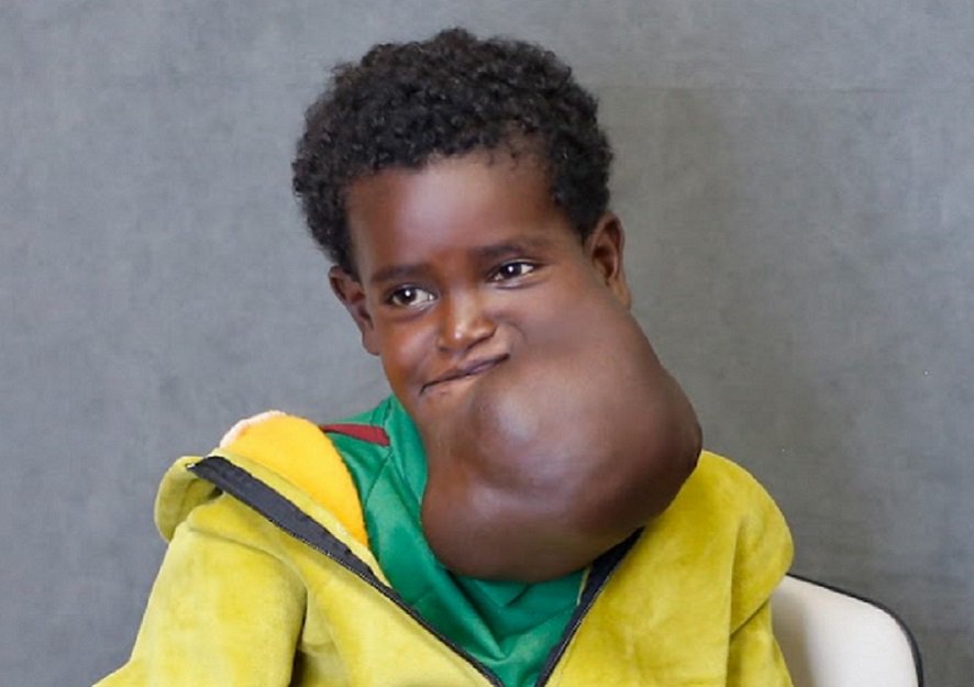 Nagalem Afa: Bonne nouvelle pour la fillette éthiopienne à la tumeur massive