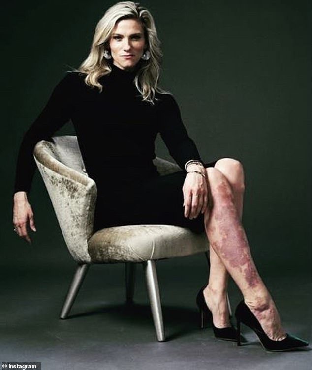 Ben Affleck S Ex Lindsay Shookus Proudly Shows Off Large Port Wine Stain Covering Her Right Leg I M Surely More Than My Birthmark Opera News