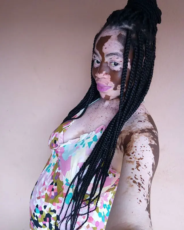 About the Vitiligo, Enam Honya Heikeens, whose Black Skin turned White