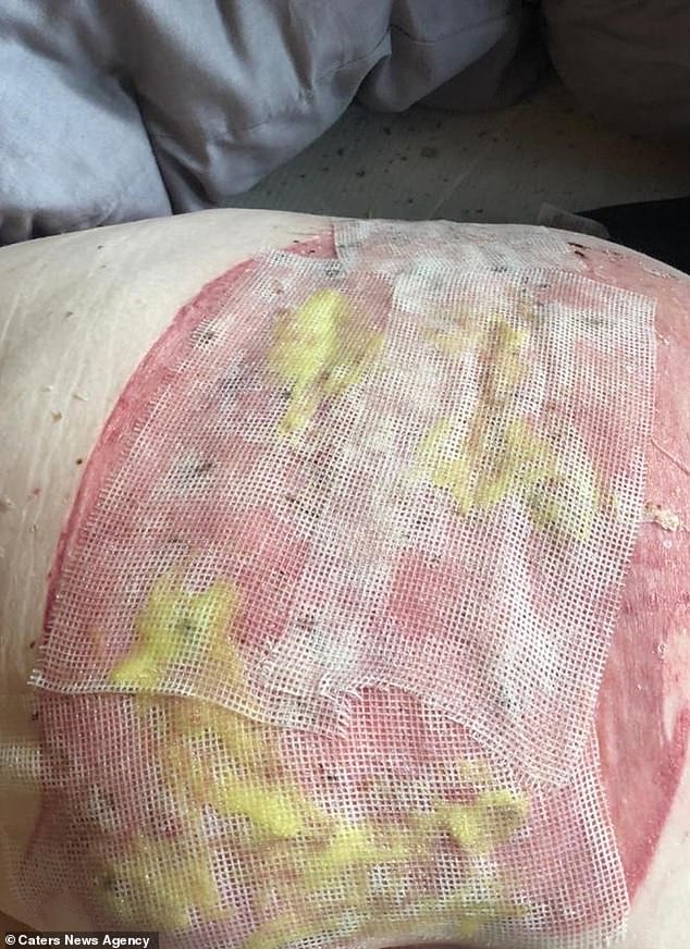 Woman suffers horrific burns on her buttocks after falling on a radiator pipe following an epileptic seizure (Photos)