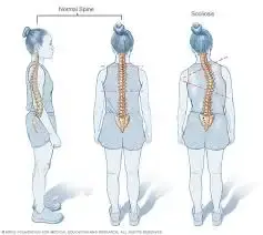 scoliosis - 3e9b2fa32d1cd022ce1feb781cef964f quality hq format webp resize 720 - Read this to ascertain if you have scoliosis