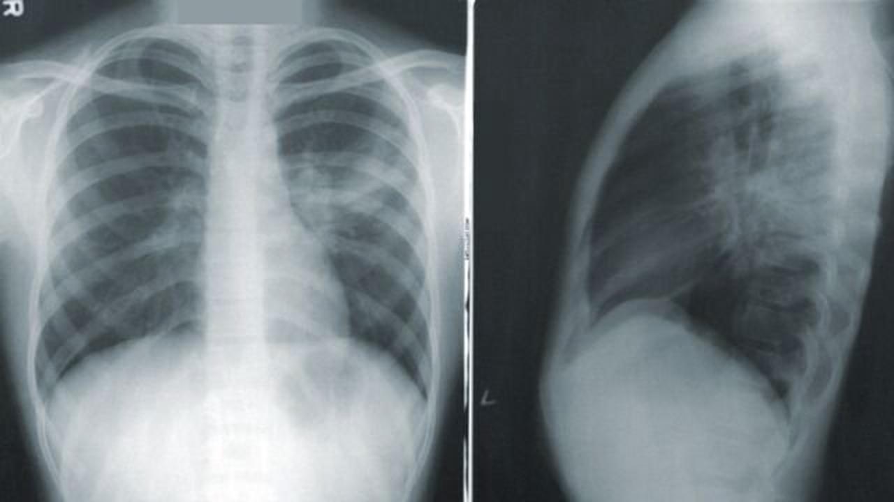 Doctor reveals shocking x-rays to show how vaccines protect your lungs from COVID