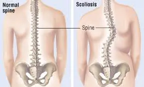 scoliosis - 50d783879604b4c466caf58643b49962 quality hq format webp resize 720 - Read this to ascertain if you have scoliosis