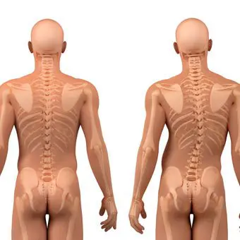 Scoliosis scoliosis - 539e8f7dfad6eb781fc62d33df0a4ba8 quality hq format webp resize 720 - Read this to ascertain if you have scoliosis