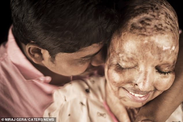Woman, 28, who survived acid attack after rejecting a marriage proposal at 15, marries a man she met while in hospital (Photos)