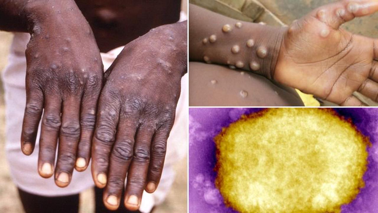 Monkeypox cases in UK more than double to 20 - as WHO says summer festivals could accelerate spread of disease