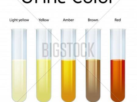 Urine Color Interpretations See The Color Of Your Urine You Must Not Ignore To Avoid Being Sick Opera News