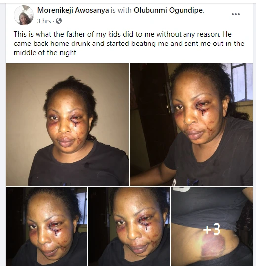 Nigerian lady shares photos of the injuries she sustained after being assaulted by her drunk baby daddy lindaikejisblog 1