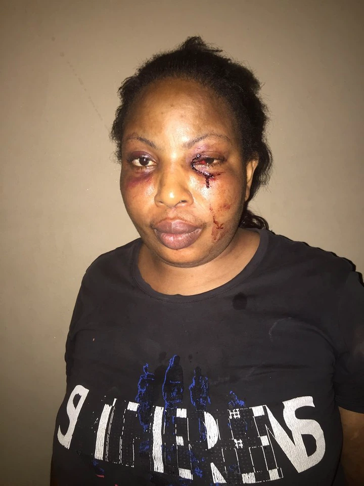 Nigerian lady shares photos of the injuries she sustained after being assaulted by her drunk baby daddy lindaikejisblog 2