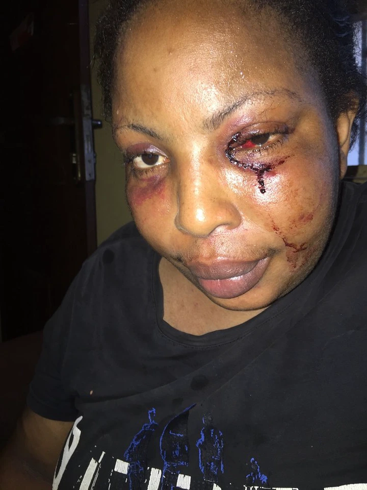 Nigerian lady shares photos of the injuries she sustained after being assaulted by her drunk baby daddy lindaikejisblog 3