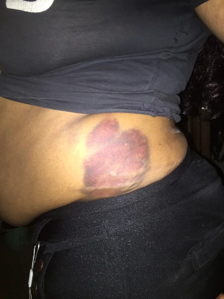 Nigerian lady shares photos of the injuries she sustained after being assaulted by her drunk baby daddy lindaikejisblog 4