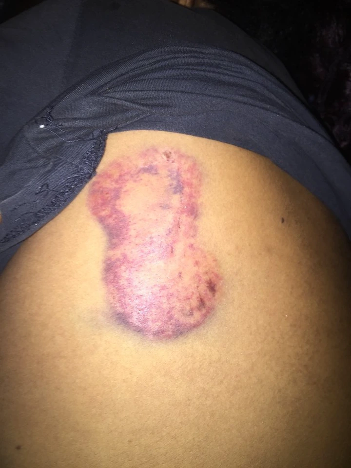 Nigerian lady shares photos of the injuries she sustained after being assaulted by her drunk baby daddy lindaikejisblog 5