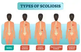 scoliosis - 6171f53c76ef412cf863c73d7348920d quality hq format webp resize 720 - Read this to ascertain if you have scoliosis
