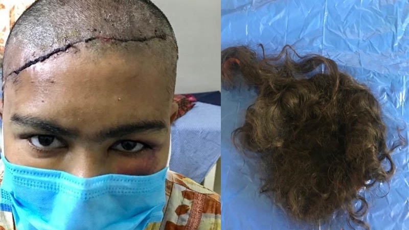 Young Woman Has Scalp Ripped Off After Hair Got Trapped In Machine Opera News