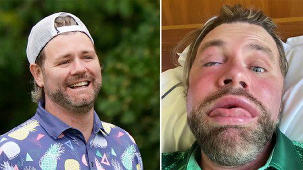Brian McFadden reveals dramatically swollen face after being stung by bee: ‘Free Botox and fillers’