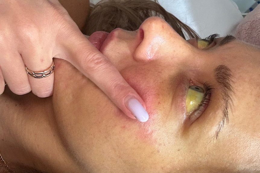 Megan Hancocks displaying jaundice in her eyes due to liver failure.