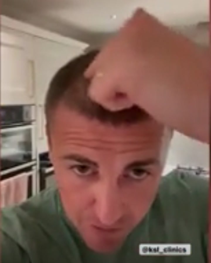 Billie Faiers' husband Greg Shephard gives update on hair transplant after  surgery - Opera News