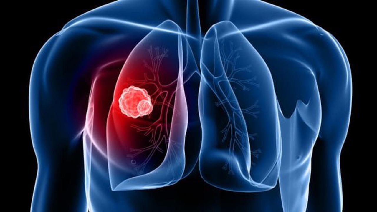 Cancer du poumon : Détecter les signes au plus tôt