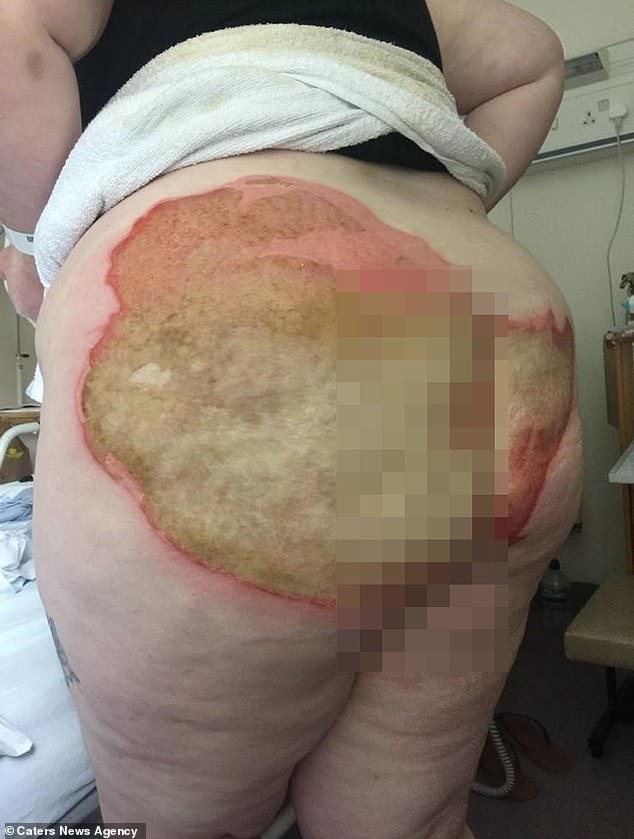 Woman suffers horrific burns on her buttocks after falling on a radiator pipe following an epileptic seizure (Photos)