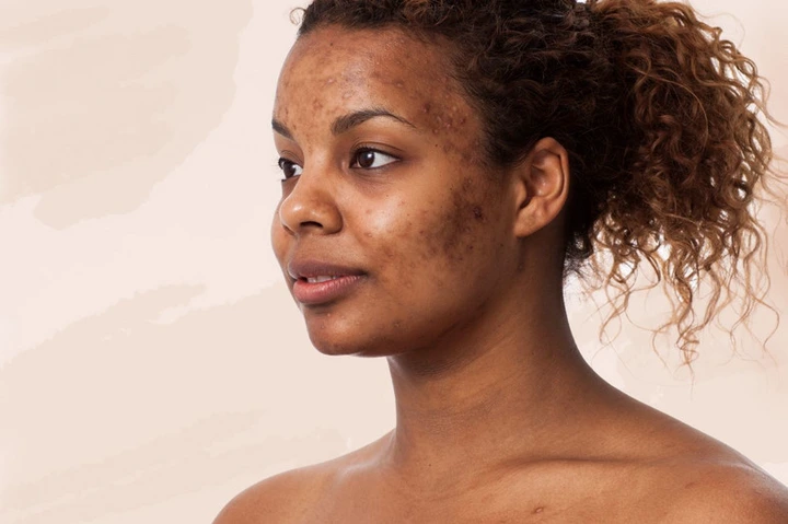 Picking acne on your face will go along to affect your skin [Tomi's Colour Pavilion]