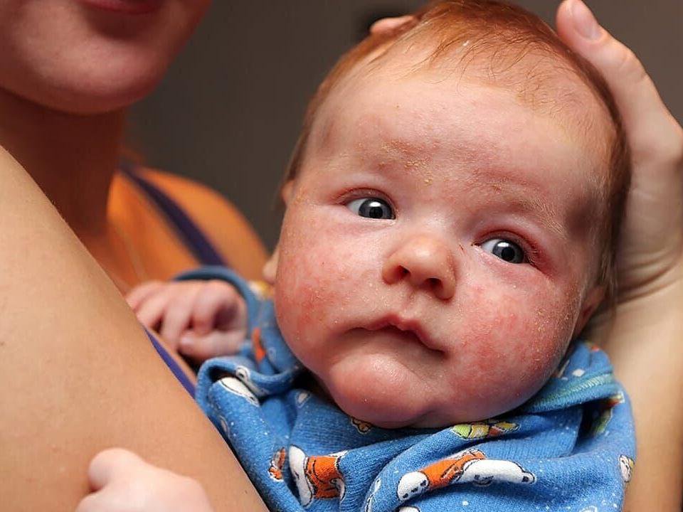 Eczema vs. psoriasis: How to tell these common skin conditions apart