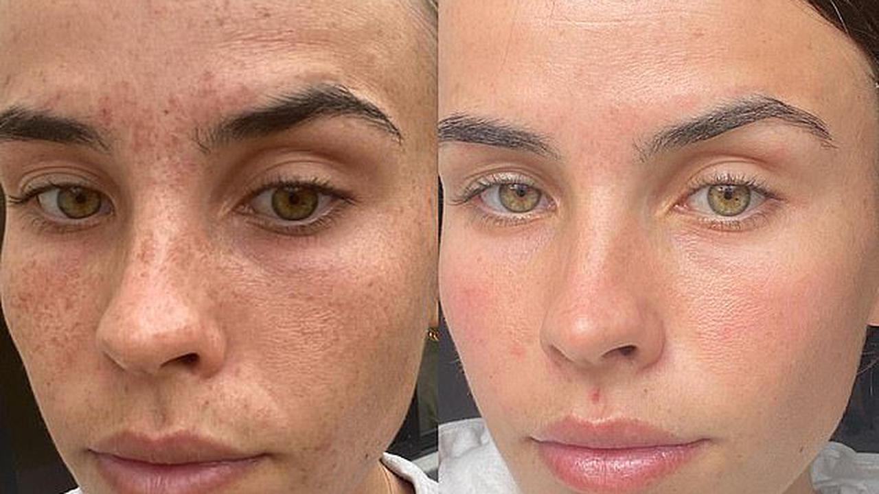 The secret to perfect skin: How 'miracle' product transformed woman's  complexion after she suffered severe pigmentation for years - Opera News