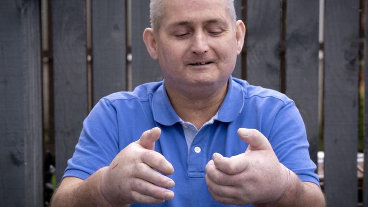 12-Stunden-Transplantation: Schotte erhält zwei neue Hände
