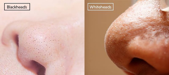 4 kinds of pimples and how to treat them