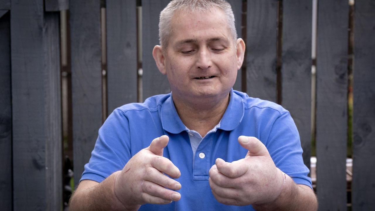 Medizin: 12-Stunden-Transplantation: Schotte erhält zwei neue Hände